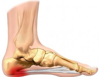 What causes heel pain and plantar fasciitis?